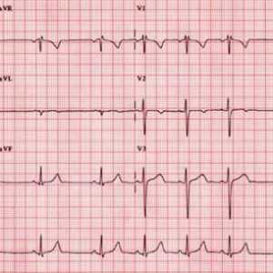Ce este migrația stimulatorului cardiac atrial?