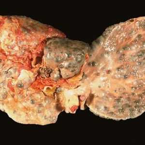 Ciroza hepatică. Cât de mult să trăiești cu un astfel de diagnostic?