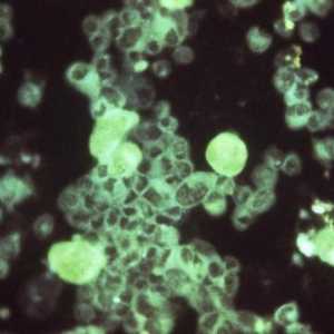 Cytomegalovirus: ce este și cât de periculoasă este boala?