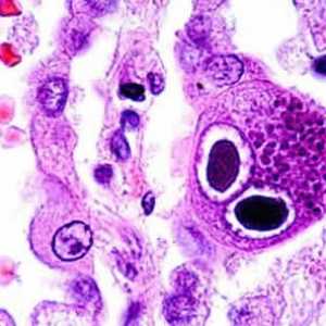 Infecția cu cytomegalovirus: simptome la femei. Cauze și metode de tratament a infecției CMV