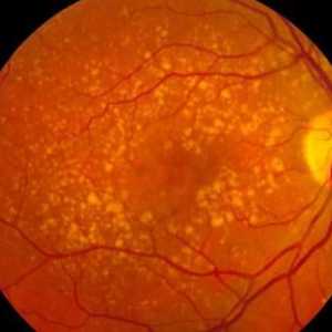 Degenerarea retinei maculare: simptome și tratament