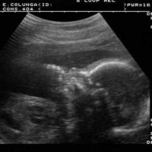 Aveți un ultrasunete la începutul sarcinii? Sarcina pe ultrasunete la începutul sarcinii (foto)