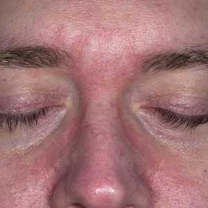Dermatita pe față - o patologie neplăcută și periculoasă