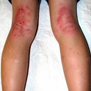 Dermatita pe picioare: cauze și tratament