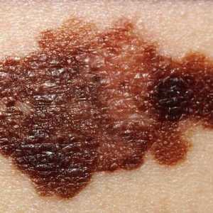 Diagnosticul melanomului cutanat: metode, recenzii