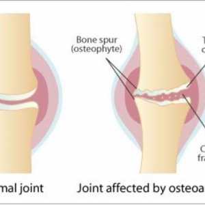 Dieta pentru artroza articulațiilor genunchiului: recomandări