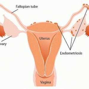 Dyufaston în endometrioză - recenzii. Eficacitatea "Dyufaston", prețul