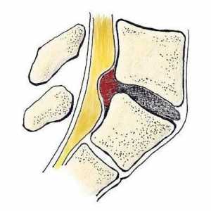 Hernia dorsală a discului: ce este, clasificarea și caracteristicile tratamentului