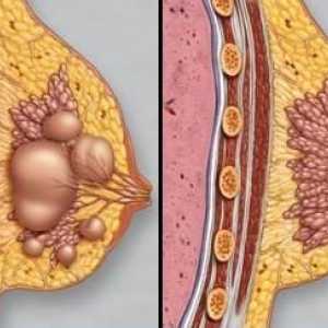 Fibroza glandelor mamare: diagnostic și tratament