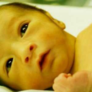 Icterul fiziologic al unui nou-născut: cauze, simptome și metode de tratament