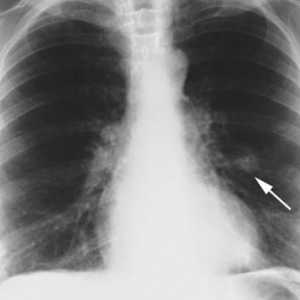 Hamartoma pulmonar: cauze, simptome, tratament