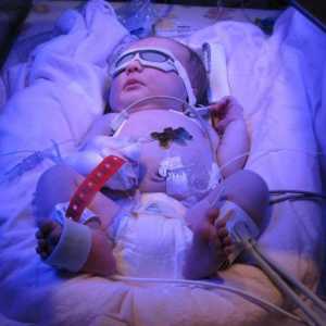 Boala hemolitică a nou-născuților: cauze și tratament