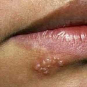 Herpesul pe buze: cum se transmite? Un remediu pentru herpes pe buză. Este herpes periculos?