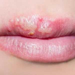 Herpesul pe buze: cum să vindeciți pentru totdeauna remedii folclorice? Este posibil să se vindece…