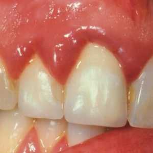 Gingivita: ce să vă spălați gura cu inflamația gingiilor?