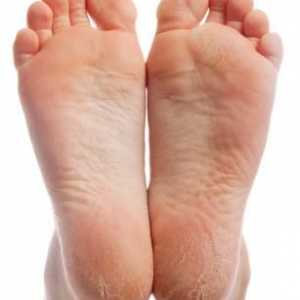 Hyperkeratoza picioarelor: tratament cu remedii folclorice