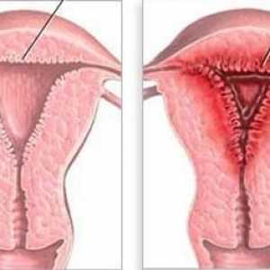 Hiperplazia endometrului: ce este? Cauze, simptome și metode de tratament