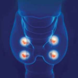 Hipoparathyroidismul postoperator: simptome și tratamentul bolii