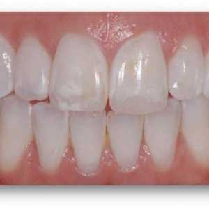 Hipoplazia smalțului dinților: diagnostic și tratament