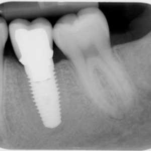 Implantarea dinților: contraindicații și posibile complicații (recenzii)