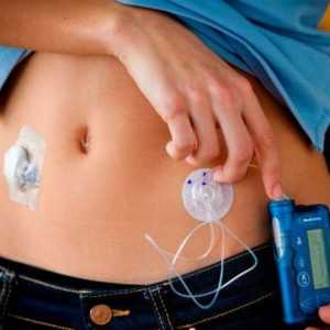 Pompa de insulină - instalare, tipuri, aplicație