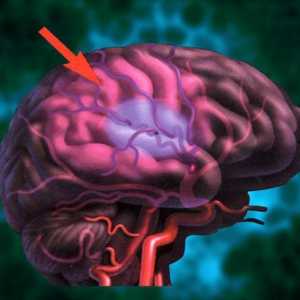 Accident vascular cerebral al creierului: prevenire. Remedii populare pentru prevenirea…