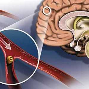 Accident vascular cerebral: semne și consecințe. Simptomele principale ale accidentului vascular…