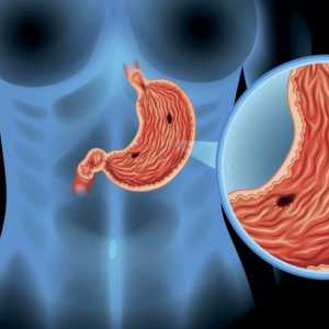 Ulcerul de stomac: cauze, simptome, diagnostice și standarde de tratament