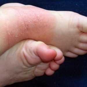 Eczemă pe picioare: simptome și tratament