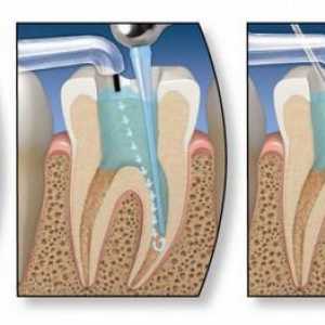 Tratamentul endodontic al dinților. Etapele tratamentului endodontic