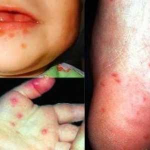 Infecția cu enterovirus la un copil: tratament, simptome, prevenire