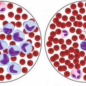 Eritrocitele din sânge sunt reduse: cauze posibile