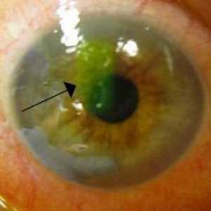 Eroziunea corneei ochiului: simptome, cauze și tratament