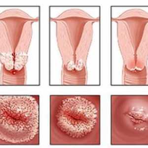 Eroziunea cervixului, moxibustion: recenzii. Mai degrabă pentru a trata eroziunea unui gât de uter?