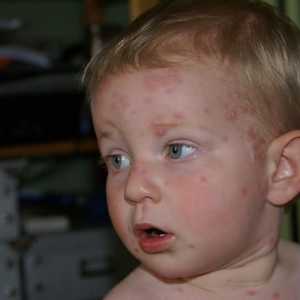 Cum si cum sa tratezi varicela la un copil?