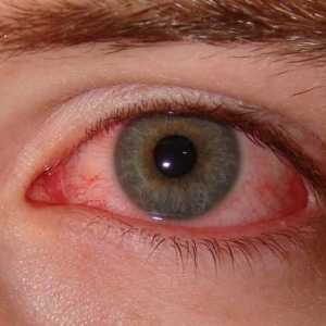 Cum sa scapi de sindromul de ochi uscat?