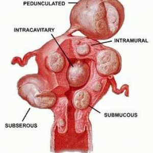 Cum să tratați miomul uterului fără intervenție chirurgicală: metode, recenzii