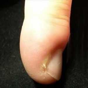 Cum să tratați abcesele pe degete: diferite terapii