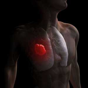 Cum sa recunoasca cancerul pulmonar intr-un stadiu incipient: simptome si cauze