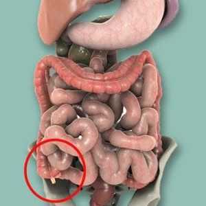 Cum sa recunoasca simptomul apendicitei