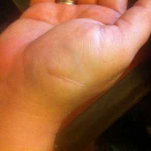 Cum de a elimina o cicatrice de la o tăietură pe braț acasă?