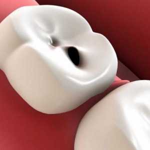 Cum acasă tratați cariile dentare? Remedii populare