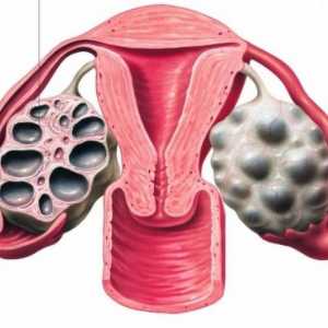 Cum arată ovarul multifollicular și ar trebui tratat?