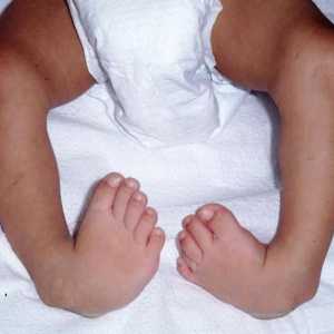 Cum de a vindeca un picior de copii într-un copil? Masaj, Exerciții, Pantofi ortopedici, Operație