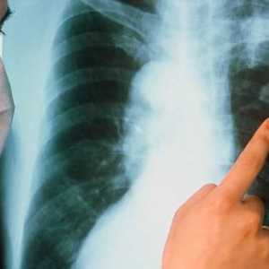 Care este cel mai important simptom al tuberculozei pulmonare?