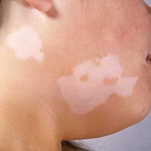 Care sunt simptomele și cauzele vitiligo?