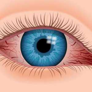 Picături pentru ochi vasoconstrictive: aplicarea și numele preparatelor