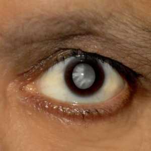 Cataracta: tratamentul remediilor populare fără intervenții chirurgicale, recenzii. Picături…