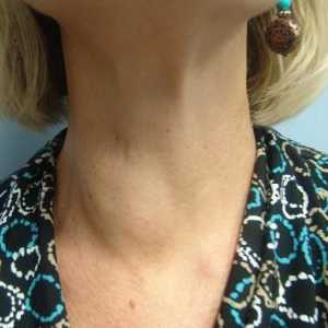 Chistul glandei tiroide - este periculos? Tratamentul chistului tiroidian