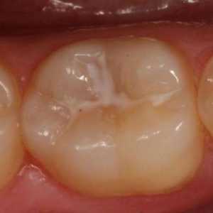 Clasificarea cariilor dentare. Tipurile și clasificarea cariilor la copii
